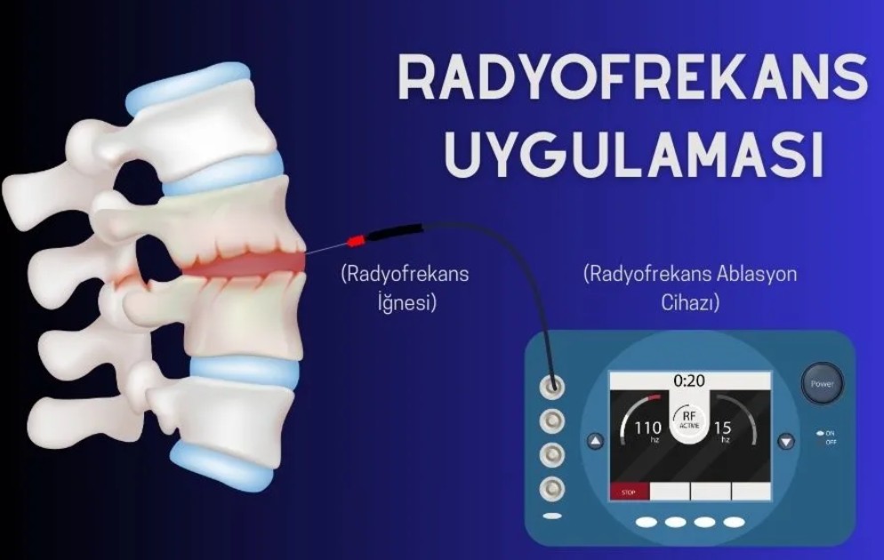 Radyofrekans Tedavisi Sonrası İyileşme Süreci Nasıldır?