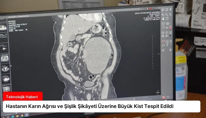 Hastanın Karın Ağrısı ve Şişlik Şikâyeti Üzerine Büyük Kist Tespit Edildi