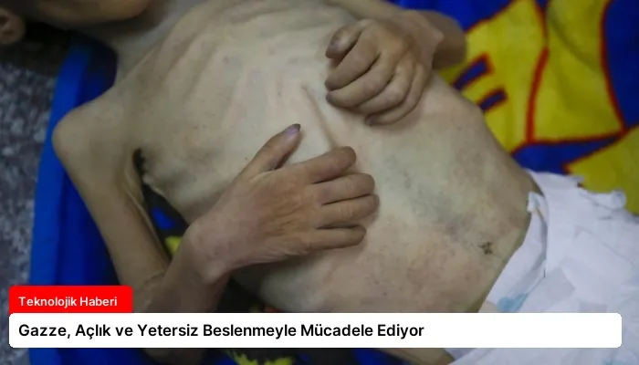 Gazze, Açlık ve Yetersiz Beslenmeyle Mücadele Ediyor
