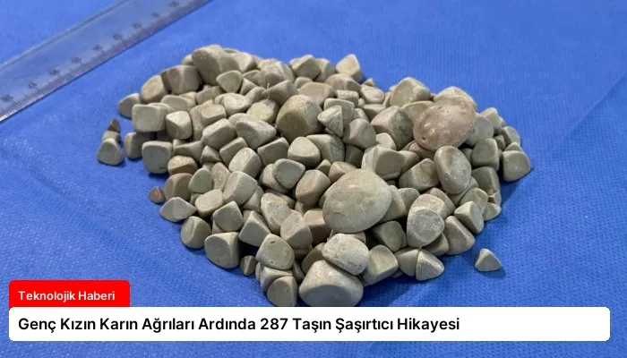 Genç Kızın Karın Ağrıları Ardında 287 Taşın Şaşırtıcı Hikayesi